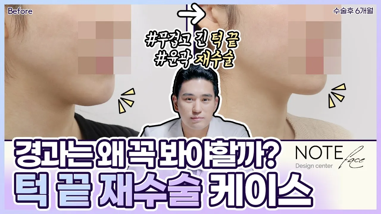 [유.케.리] 📍 CT로 보는 케이스 리뷰 l 턱 끝 재수술 (ㅅ절골 + 전진술) l