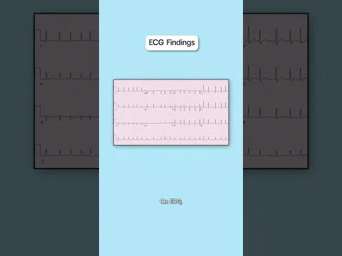 Atrial fibrillation overview