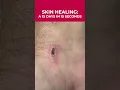 Download Lagu 15 Days of Skin Healing in 15 Seconds: Amazing Timelapse! 🩹