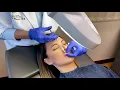 Lip Filler With Restylane Kysse St Louis Cosmetic Surgery