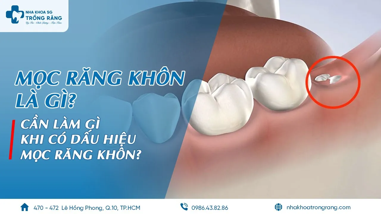Outline Video Mọc răng khôn là gì? | Cần làm gì khi có dấu hiệu mọc răng khôn?