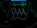 Lagu heart rate monitor // free sound effects