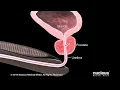 What is Benign Prostatic Hyperplasia BPH