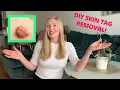 Download Lagu DIY Skin Tag Remover REVIEW!