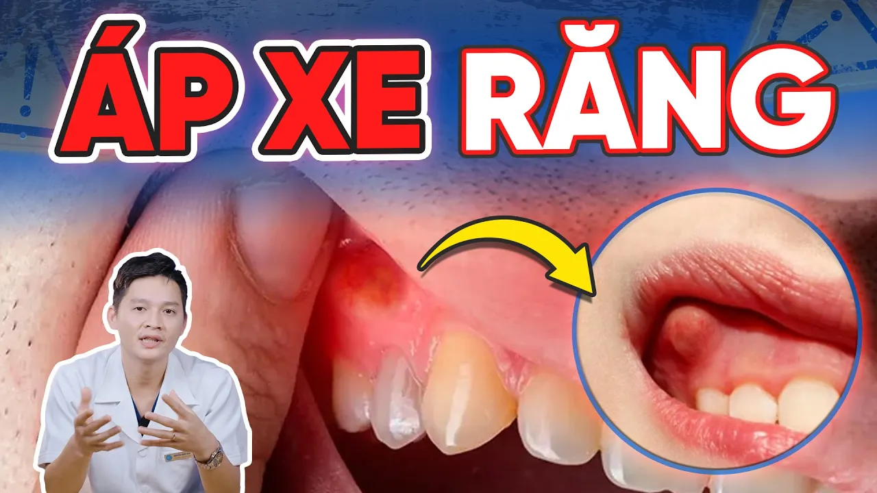 Outline Video Áp Xe Răng Là Gì? 3 Cách Điều Trị Áp Xe Răng Ngăn Nhiễm Trùng Lan Rộng