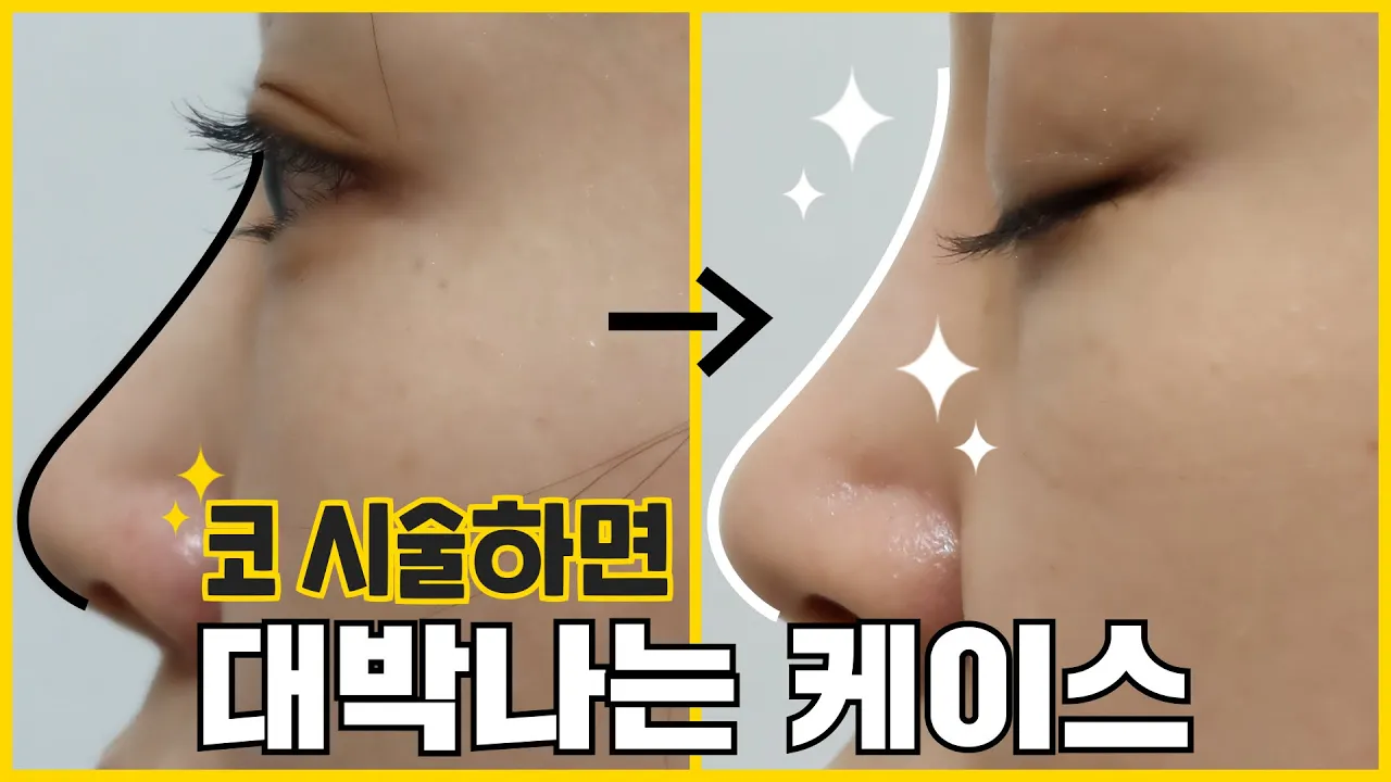 필러? 실리프팅? 내 코는 뭘 하면 대박일까? | 실리프팅, 코필러, 코실리프팅 | 차이의원 조원진 대표원장