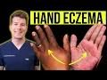 Doctor explains how to recognise and treat HAND ECZEMA dermatitis Causes symptoms prevention