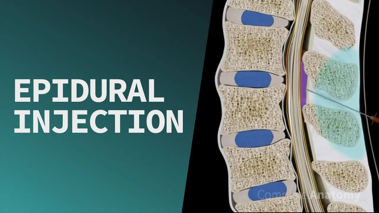Epidural Injection