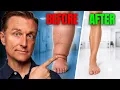 Lymphedema What Doctors Don t Tell You Diet Connection