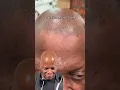 Download Lagu Funny #hairtransformation Try Not To Laugh 😂 #scalpmicropigmentation #jayz #laughing #hairlosscure