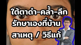  วิธีรักษาอาการรอบดวงตาคล้ำจากภูมิแพ้ควรทำอย่างไร 