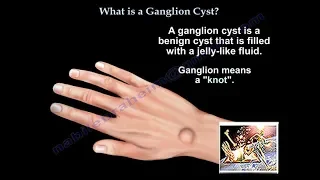 What Is A Ganglion Cyst - Everything You Need To Know