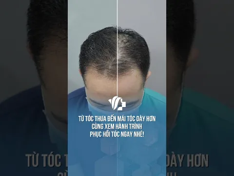 Từ tóc thưa đến mái tóc trông dày hơn, cùng xem hành trình phục hồi tóc ngay nhé