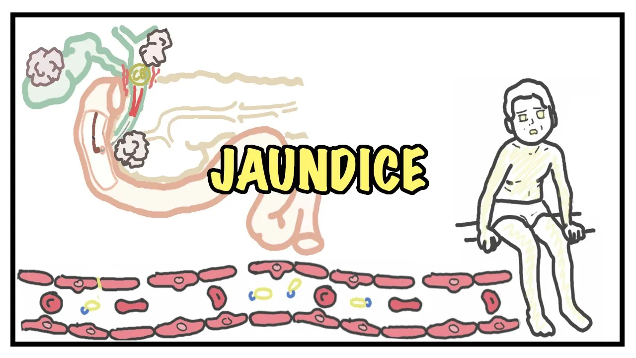 Approach to Jaundice - types and causes of hyperbilirubinemia, investigations
