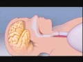 What Is Sleep Apnea