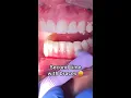 What happens if you get braces a second time Tooth Time Family Dentistry New Braunfels Texas