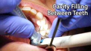 Download Dentist Filling A Cavity Between Teeth MP3