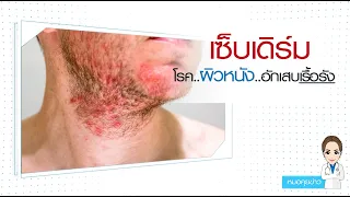 โรคผื่นแพ้ต่อมน้ำมัน หรือที่เรียกกันว่าโรคเซฟเดิม มีอาการอย่างไรบ้าง