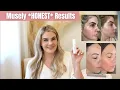 Musely The Spot Cream - Did it work on my melasma