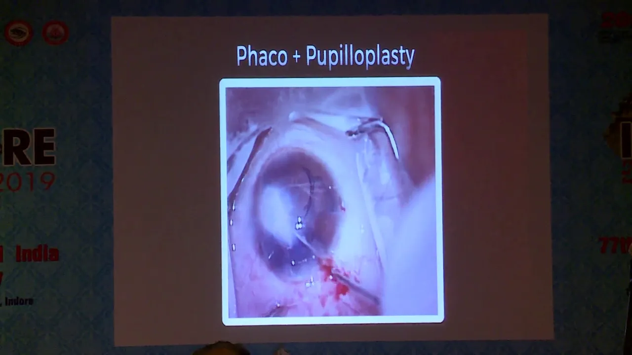 AIOC2019   GP141   Topic   Phacoemulsification in corneal haze   Dr  Namrata Sharma