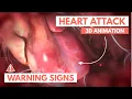 Download Lagu Recognizing a heart attack | 3D Animation