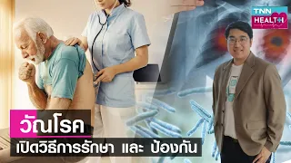 การรักษาวัณโรคใช้เวลานานแค่ไหน และมีวิธีการอย่างไร