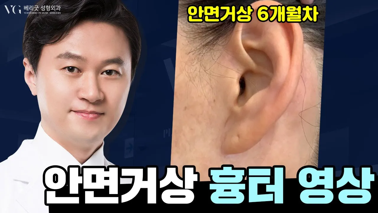 #임영민원장 20년경력 임영민원장님의 안면거상, 귀흉터 영상 / 안면거상 흉터 궁금하다면? 안면거상 6개월차의 흉터 자세히 보기 Click!