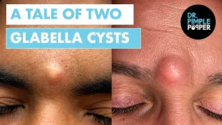 Dr. Pimple Popper vs. Two Glabella Cysts