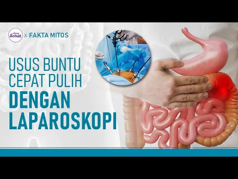 Laparoskopi, Operasi Usus Buntu Minim Nyeri dan Cepat Pulih