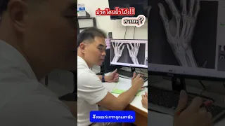  อาการปวดที่โคนนิ้วโป้งสองข้างเกิดจากสาเหตุอะไร 