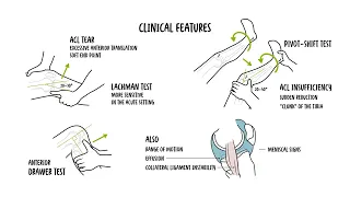 ACL Tear Explained: Causes, Symptoms, Diagnosis and Treatment