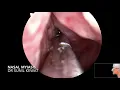 Download Lagu Nasal Myiasis | Maggots in Nose | maggots removal