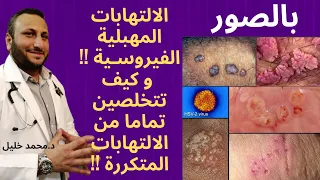 بالصور الالتهابات المهبلية الفيروسية و كيف تتخلصين تماما من الالتهابات المتكررة د محمد خليل 