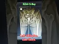 Download Lagu Left fallopian tube block (H.S.G) X-RAY #_shorts #_viral_ #_medical #_student #_collage