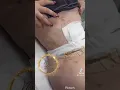 Lymphatic Drainage Massage Brooklyn New York after Liposuction and BBL instagram najj - body