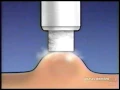 Dr Scholl s Freeze Away Television Commercial 2005
