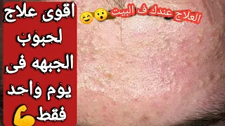 ازاى تتخلصي من حبوب الجبهه فى يوم واحد بمكون موجود فى كل بيت علاج حبوب الوجه 