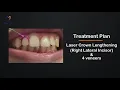 Bridal Smile Makeover in Chennai low cost DSD Smile designing porcelain veneers teeth gap closure