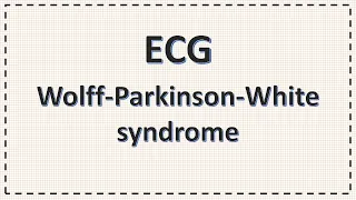 WPW Syndrome ECG Wolff Parkinson White Syndrome ECG Changes Simplified Delta Wave 