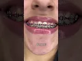 Download Lagu Best Braces Colors for Whiter Looking Teeth Part 1