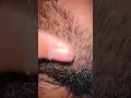 Download Lagu Ingrown hairs #removal #skincare #satisfying #haircare #viral #ingrownhairs