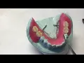 Laboratory procedures for fabrication of an acrylic based removable partial denture