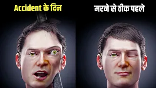सिर में लोहे की छड़ घुस जाने के बाद भी ये व्यक्ति 12 साल तक कैसे ज़िंदा रहा