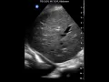 Right Pleural Effusion Clinical Image