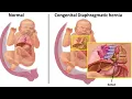 Diaphragmatic Hernia Repair CPT code - simplify medical coding