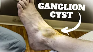 Download HUGE Ankle Ganglion Cyst Aspiration Surgery - *Foot \u0026 Ankle Treatment* MP3