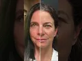 Upper Blepharoplasty Rhinoplasty Results by Dr Shashi Kusuma Suria Cosmetic Surgery Weston FL