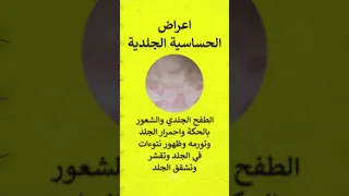 اعراض الحساسية الجلدية   حكة في الجلد  الهراش  وأبرز أعراضها العامة والأكثر شيوع ا دندنها