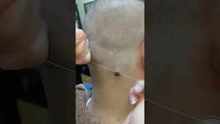 إزالة زوائد جلديه على فور  إزالة زوائد جلديه على فور