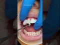 Download Lagu 4 Composite Veneers #shorts